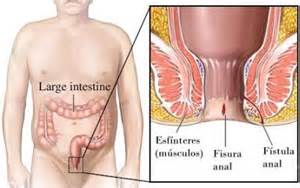 Analfissur Altsberglotion Produkte