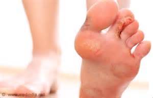 Fußpilz Behandlung und Therapie