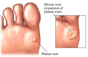 Plantarswart