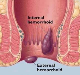 Symptome bei Hämorrhoiden: